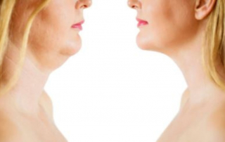 Mommy makeover en León