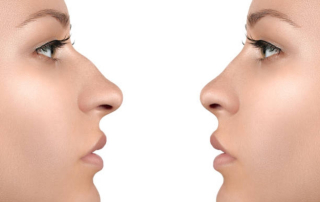 rinoplastia en León