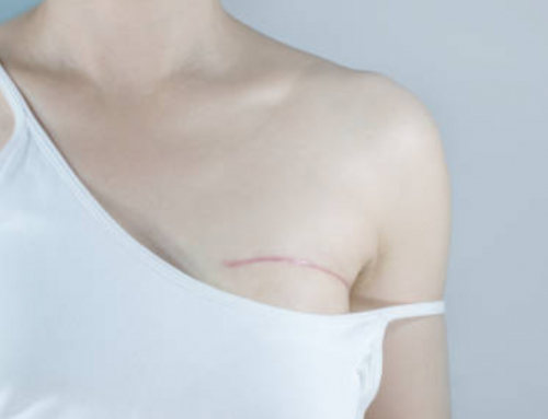 ¿En qué consiste la reconstrucción mamaria después de la mastectomía?