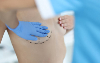 Levantamiento de busto