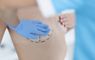 levantamiento de busto