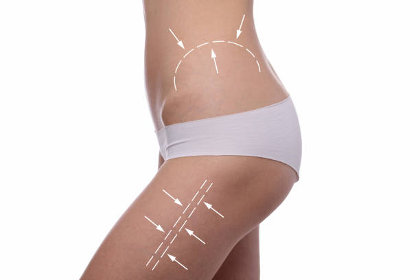 Lipoescultura