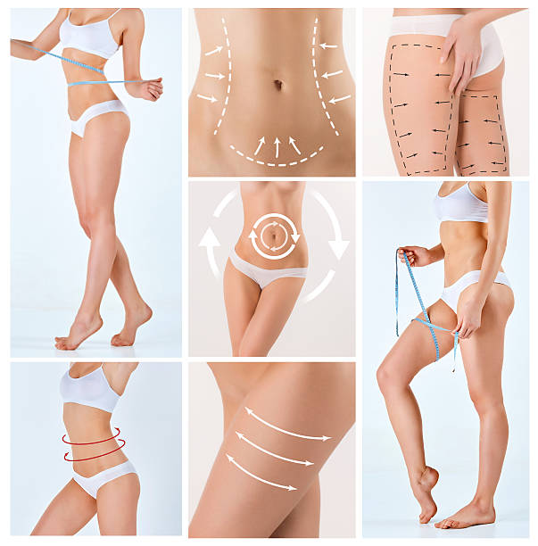 Lipoescultura