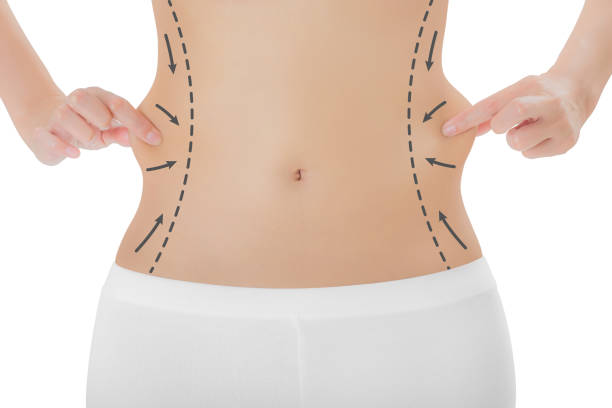 lipoescultura