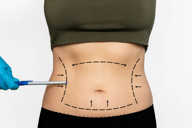 lipoescultura
