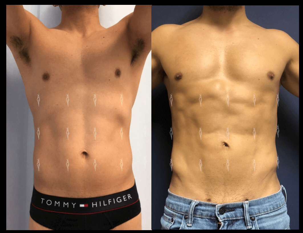 lipoescultura