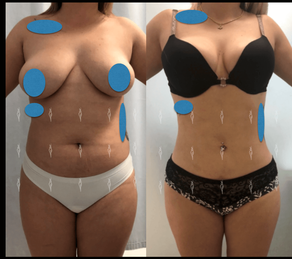 lipoescultura
