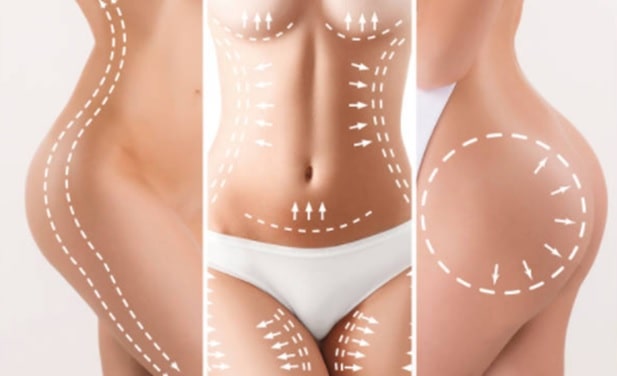 lipoescultura