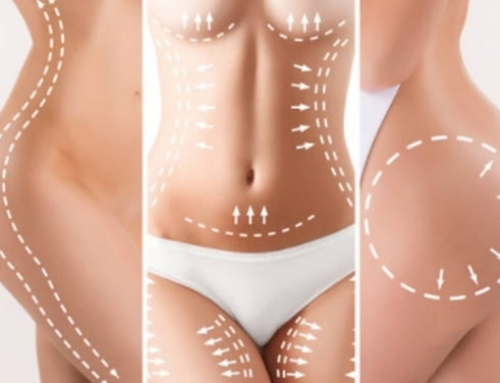 ¿Cuántos kilos se pueden perder con una lipoescultura?