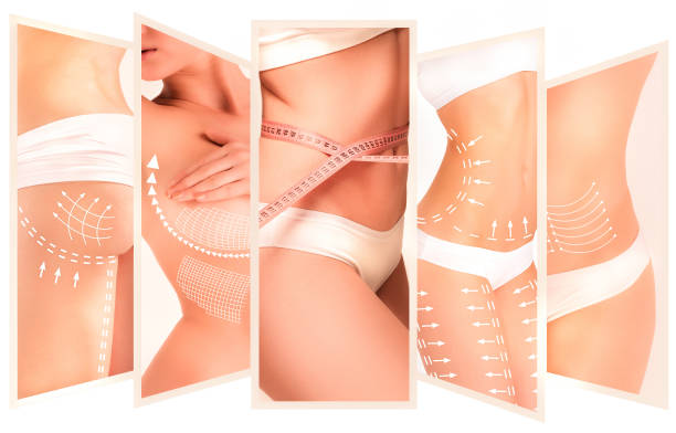 Lipoescultura