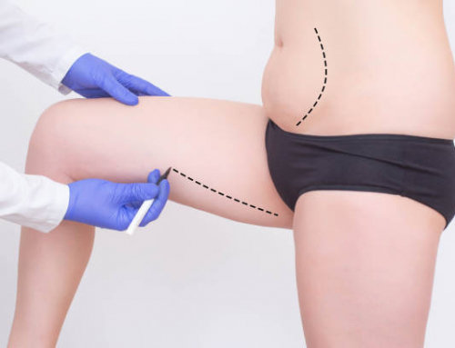 ¿Cuáles son los resultados de la lipoescultura?