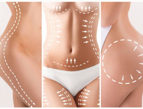 ¿Qué áreas se pueden tratar en una lipoescultura?