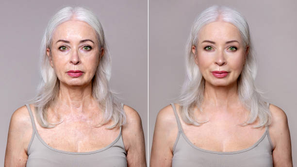 antes y después del estiramiento facial