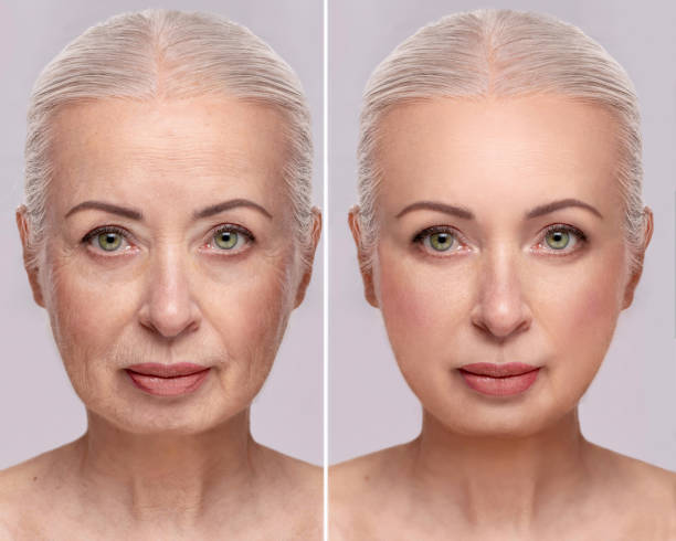 antes y después del estiramiento facial
