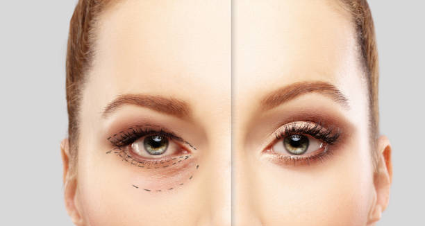 comparativa de la blefaroplastia