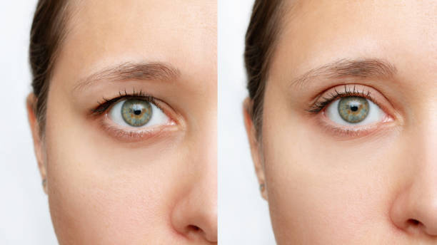 resultados antes y después de la blefaroplastia