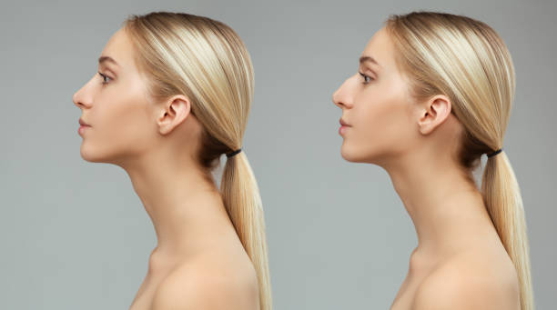 comparativa del antes y después de rinoplastia