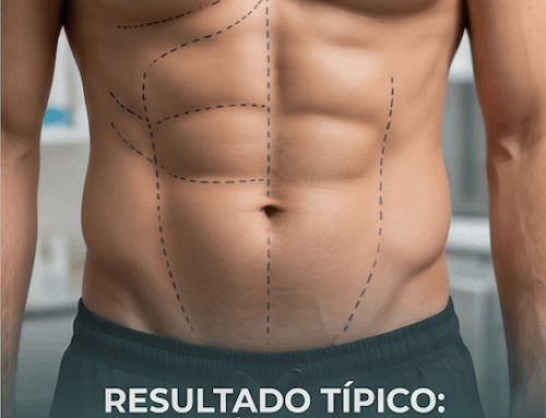 ¿Qué es la marcación abdominal y cómo se logra mediante la lipoescultura?