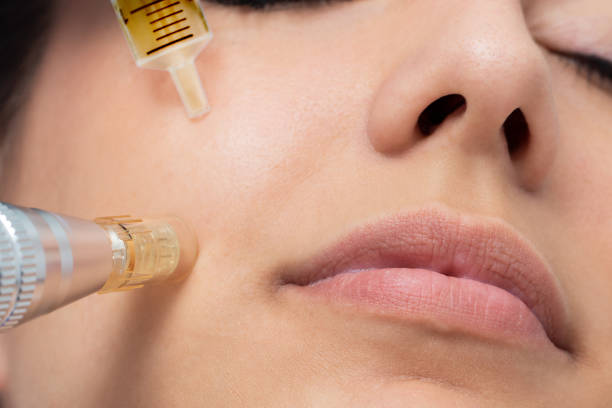 aplicación de bioestimuladores en rostro de mujer