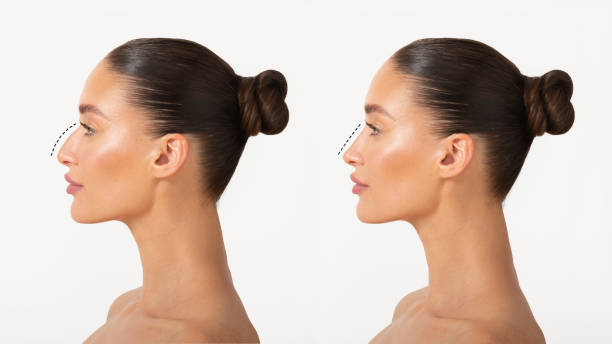 mujer con rinoplastia